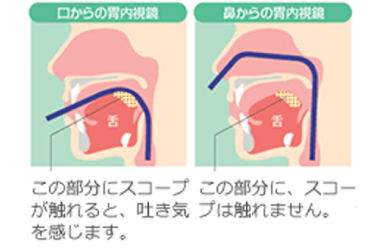 苦痛・吐き気の少ない内視鏡検査です